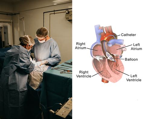 Balloon Valvuloplasty, Mitral /Pulmonary Aortic – Heart Center Ranchi