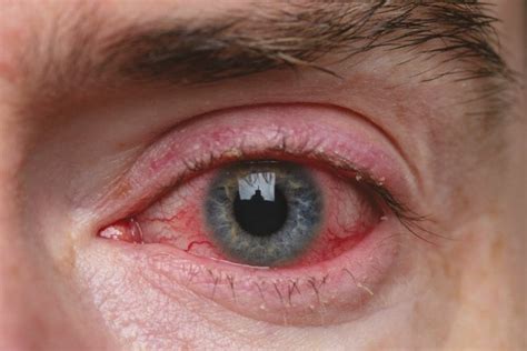 10 Tips For Managing Ocular Rosacea & Meibomian Issues