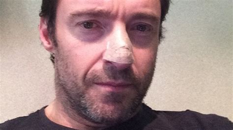 Hugh Jackman treated for skin cancer, posts picture of his bandaged ...