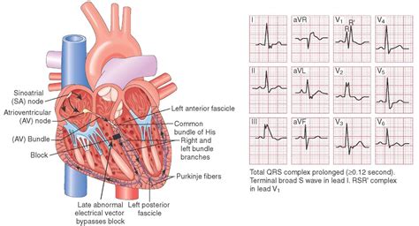 Diagnostic ECG—The 12-Lead (Clinical Essentials) (Paramedic Care) Part 4