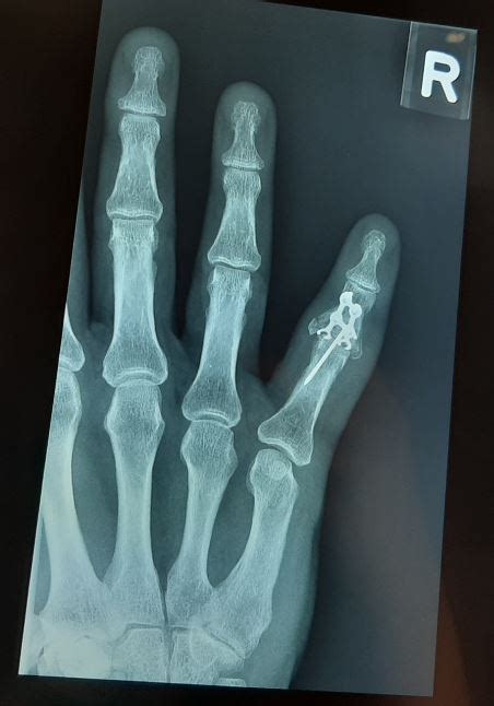 Broken Finger | 🏥Singapore Orthopaedic & Sports Medicine