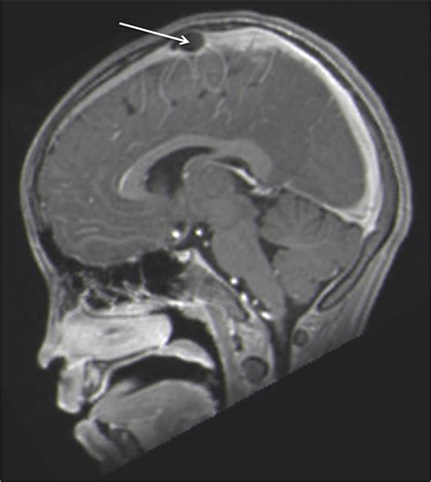 Cureus | Giant Arachnoid Granulation Associated with Anomalous Draining ...