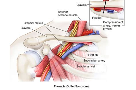 THORACIC OUTLET SYNDROME | Sport Med School