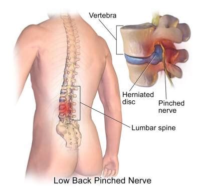 Lower back pain advice - Milton Keynes University Hospital