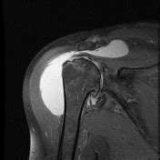 Subdeltoid Bursitis Mri