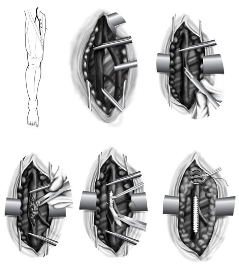 Endarterectomy of the Femoral Artery on Behance