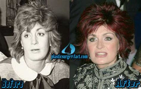 Sharon Osbourne Plastic Surgery Before and After Photos