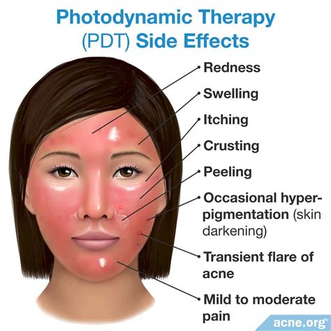 Blue Light Photodynamic Therapy For Precancerous Lesions | Shelly Lighting