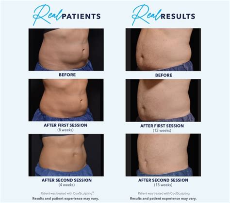 How Long Does Coolsculpting Last - Healthy Anozo