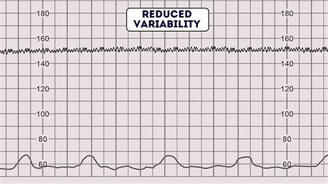 Sinusoidal fetal heart rate