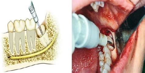 Impacted tooth- Sign, Symptoms, Treatments know in details