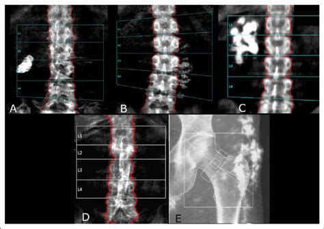 Nonosseous calcifications are frequently encountered on dual-energy ...