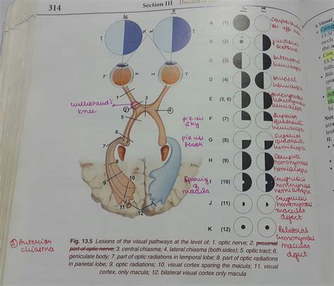 Medicowesome: Lesions of visual pathway