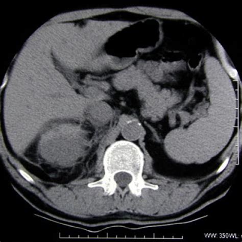 Complications following lithotripsy | Eurorad