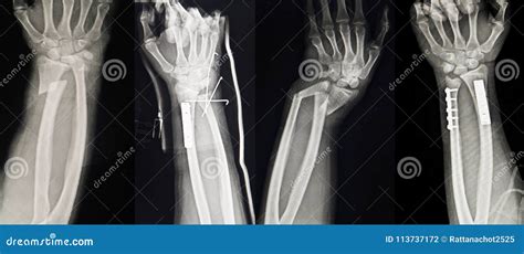 Collection Of Human X-rays Showing Multiple Hand Fracture. Stock ...