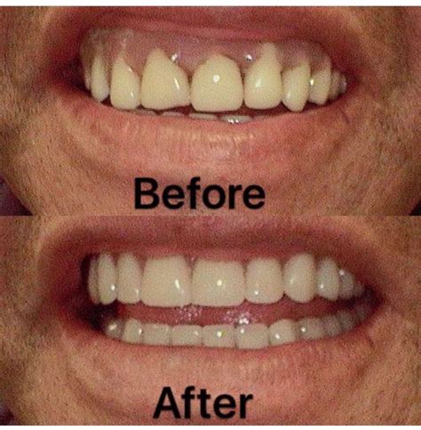 DENTURE-BEFORE-AND-AFTER(4) - Dentist Houston TX | Acorn Dental