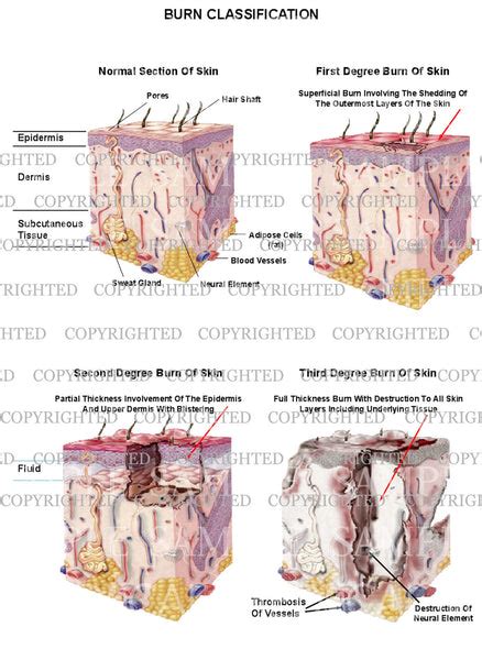 Burn classification chart — Medical Art Works