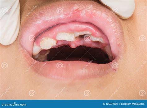 Close Up Tooth Loss in Children Stock Photo - Image of expression ...