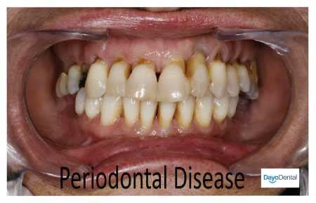 Your Ultimate Guide to Periodontal Disease - Periodontitis
