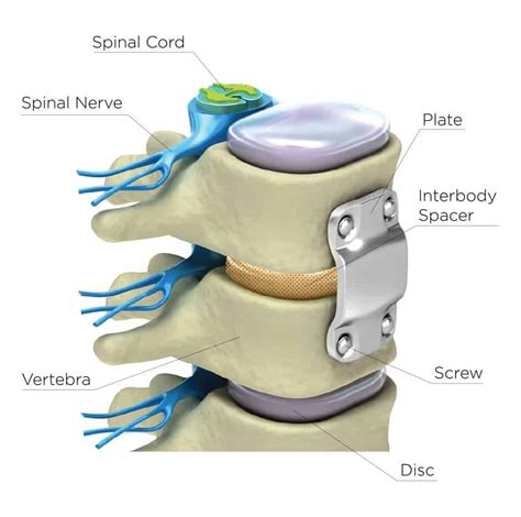 Anterior Cervical Discectomy With Fusion (ACDF) | BioSpine Institute