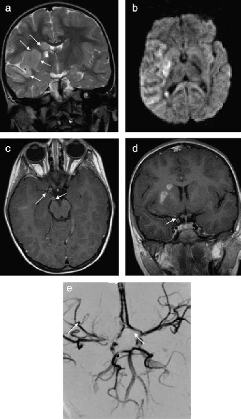 Figure 4 from Imaging of Cerebral Vasculitis | Semantic Scholar