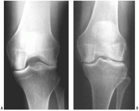 Arthroscopic Chondroplasty and/or Debridement | Musculoskeletal Key