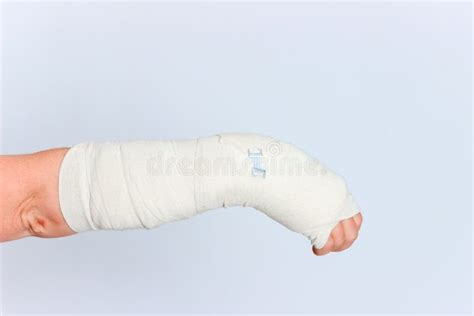 Young Female with Broken Hand in Cast Stock Photo - Image of injury, disease: 71320742