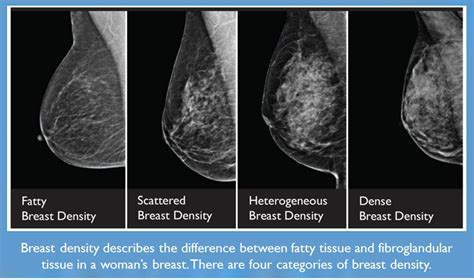 How Does Aging Change Your Breast Density? - Wake Radiology