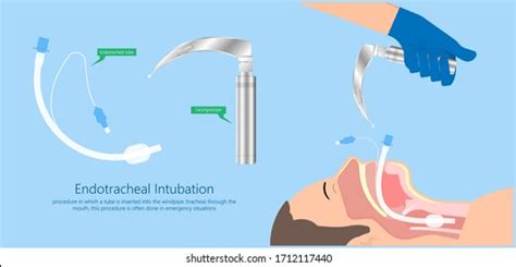 Endotracheal Intubation Icu Care Unit: Over 39 Royalty-Free Licensable Stock Vectors & Vector ...