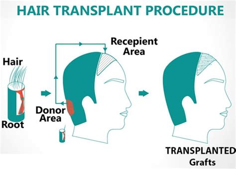 Virender Sehwag and his popular Hair Transplant Surgery - Read More