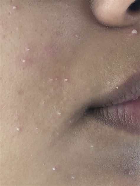 Can anyone explain what this is?? Cluster of small white bumps - General acne discussion - Acne.org