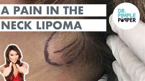 Queen of Pops Removes A Pain in the Neck Lipoma - Lipoma Love - Dr. Pimple Popper