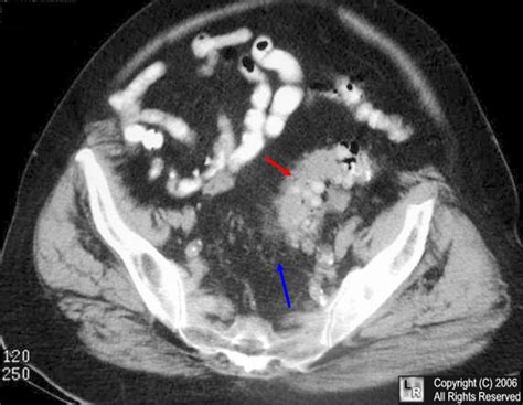 LearningRadiology - Diverticulitis, Diverticulosis