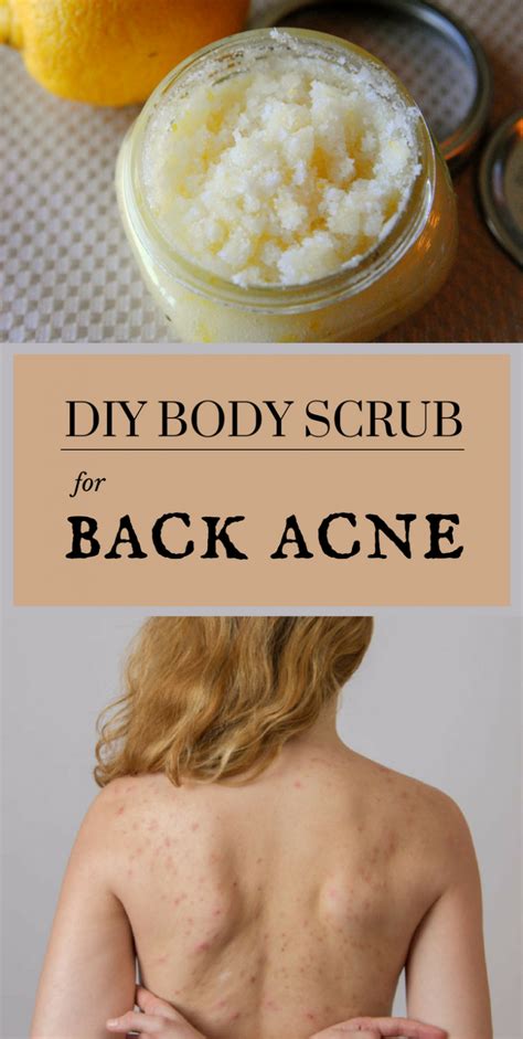 DIY Body Scrub For Back Acne – PINS click | Diy body scrub, Diy body scrub recipes, Diy body