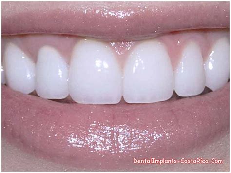 Emax Dental Crowns in Costa Rica | IPS.E Max Crowns in Costa Rica | Dental Implants in Costa Rica