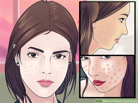 4 Ways to Prevent Acne Scars - wikiHow