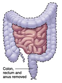 Krames Online - Having Bowel Surgery: Proctocolectomy with Permanent Ileostomy