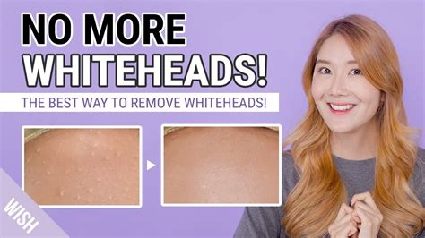 How To Remove Whiteheads, Small Bumps | Whitehead Removal to Prevention Care Routine | Wish,Try ...