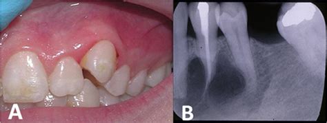 Towards better understanding of giant cell granulomas of the oral cavity | Journal of Clinical ...