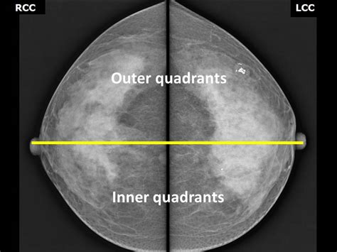 Mlo Mammography Quadrants Clock