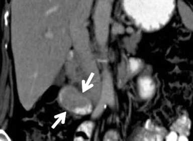 Recurrent Episodes of Acute Pancreatitis Due to Duodenal Gangliocytic Paraganglioma: Report of a ...