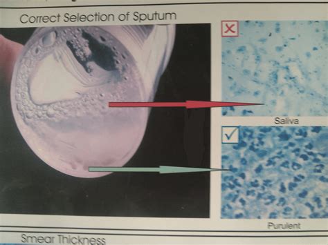 Is there an acceptable level of 'unsatisfactory (salivary) sample' for TB sputum microscopy ...