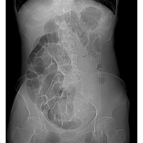 Positive Psoas and Obturator Signs [64]. | Download Scientific Diagram