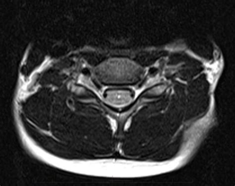 MRI Spine - Paediatic MRI Series