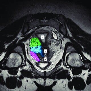 Longitudinal axis of a normal pelvis with a retroverted uterus... | Download Scientific Diagram