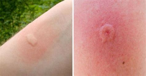 12 Common Bug Bites And How To Recognize Each One | Insect bites, Bug bites, Fly bites