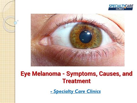 PPT - Eye Melanoma - Symptoms, Causes, and Treatment PowerPoint ...