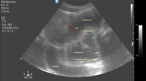 Small Bowel Obstruction ~ Ultrasound Cases Info