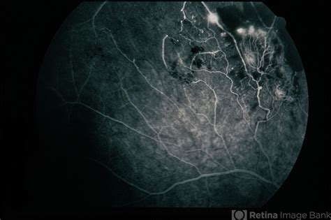 Eales Disease - Retina Image Bank