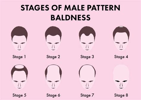 how to tell if you have male pattern baldness Baldness prevention ...